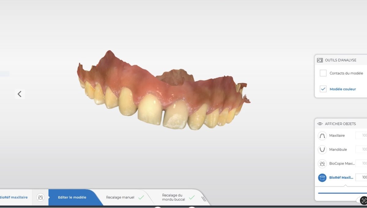 Workflow numérique — scan 3D maxillaire